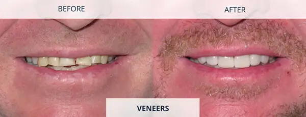 Chipped or Broken Teeth