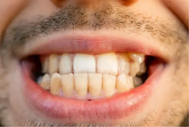 Crowded Teeth or Gaps