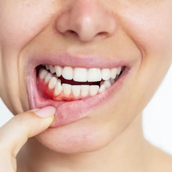 Gum Disease Treatment Paddington
