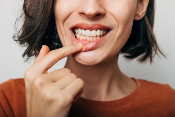 Gum Recession