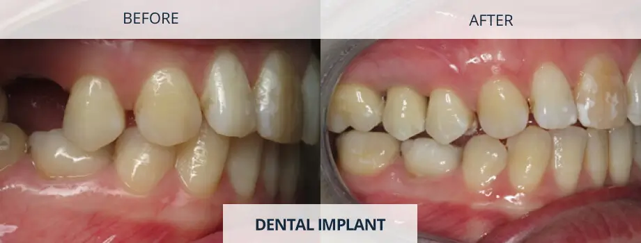 I Don’t Want to Wear Dentures