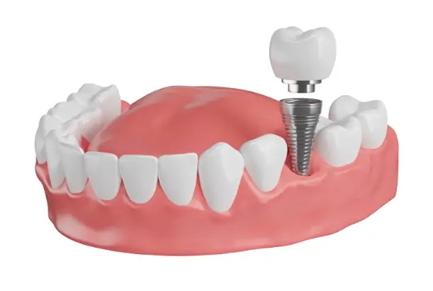 I Don’t Want to Wear Dentures