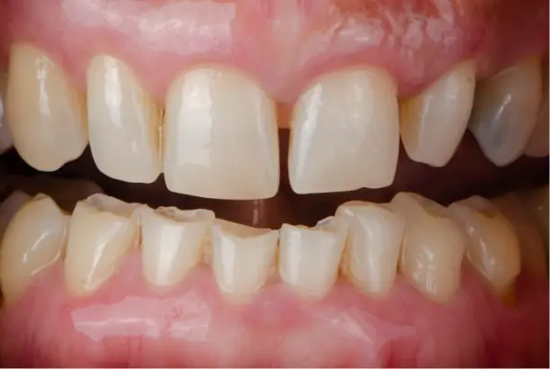 I Have Chipped or Broken Teeth