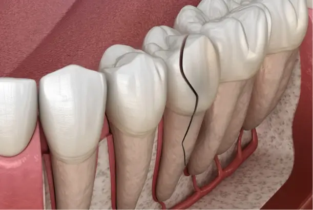 I Have Cracked or Worn Teeth