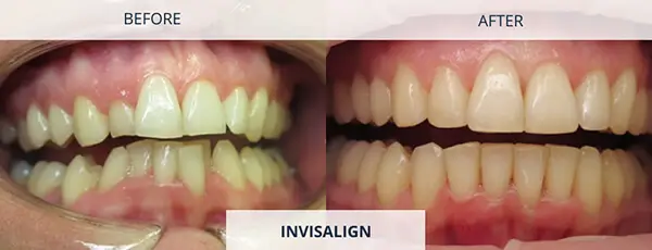 Align My Teeth Braces