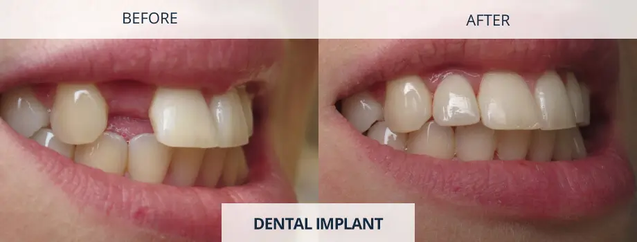Missing Teeth