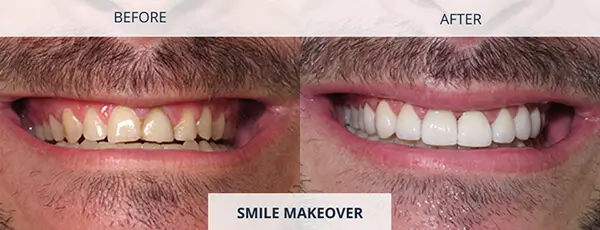 Smile Makeover