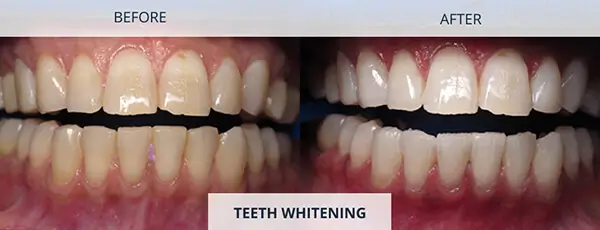 Smile Concerns-Teeth Whitening