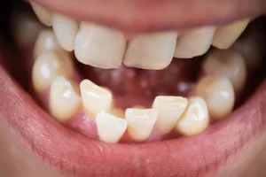 crooked bottom teeth