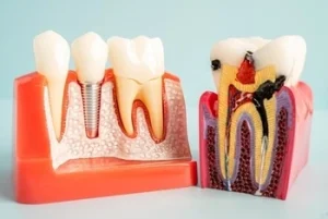 How Long Does Root Canal Last after How Long Does Root Canal Last after