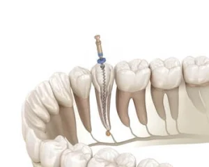What Causes Cracked Teeth root canal What Causes Cracked Teeth root canal