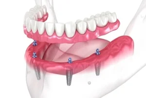 dental implants full set
